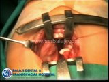 Bilateral Cleft Lip and Palate - Palatal Repair with Vomerine flap - Dr. S.M Balaji
