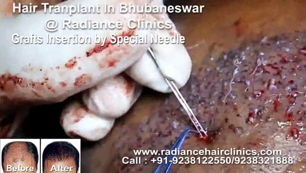 Hair Transplant in Bhubaneswar