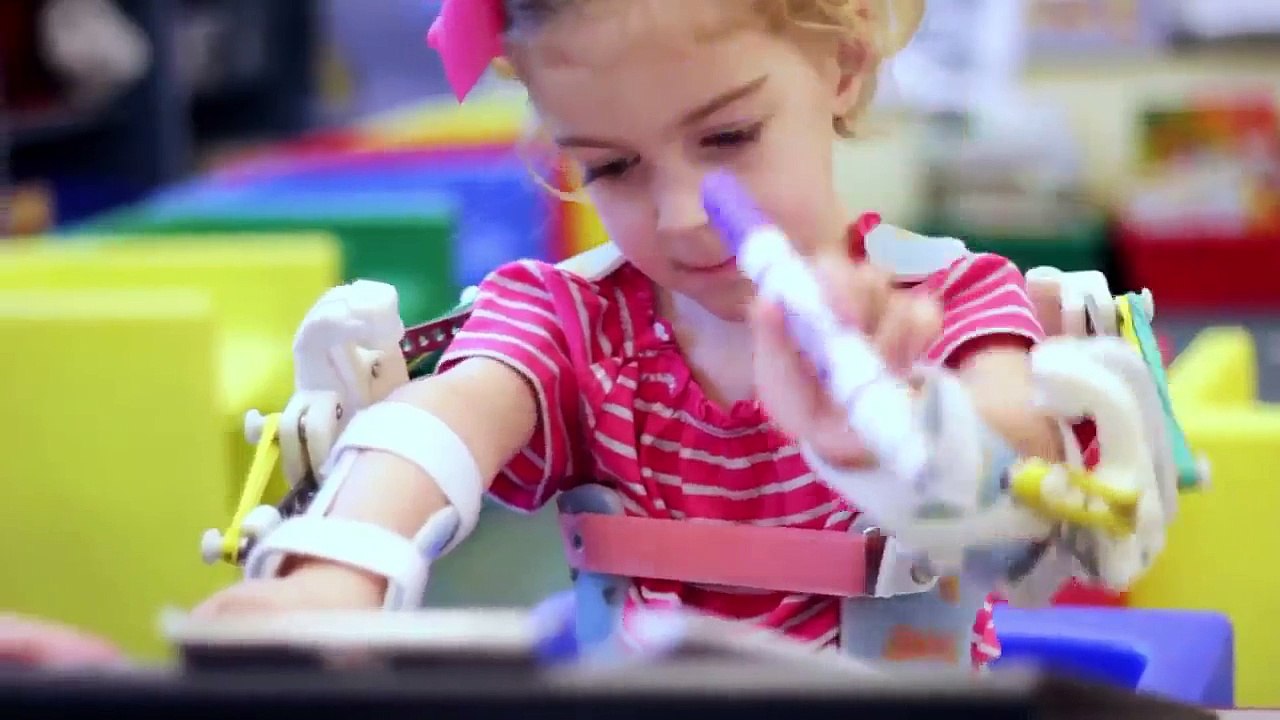 Prosthetic Limbs A 3D-Printed Magic Arms