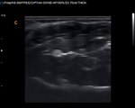 Median Nerve with Chison Q9 Color Ultrasound