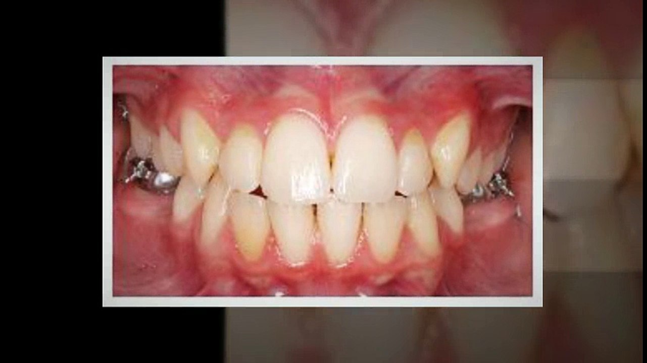 Ebert - Orthodontics Fort Collins - (970) 490-6065