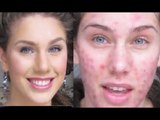Makeup Tutorial: Acne Foundation Routine for Cystic, Scaring, Oil and Blackheads - Cassandra Bankson