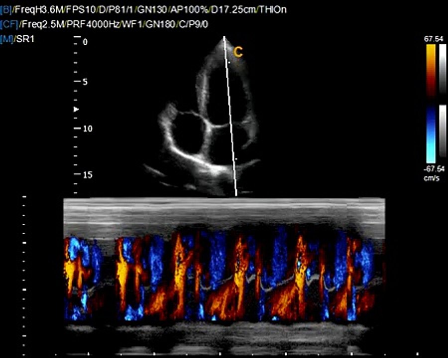 Qbit Cardiac Sonography / Chison Q9 / Phased Array Probe