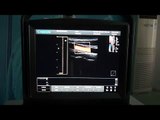 Chison ECO5 Ultrasound Demonstration | Vascular, Liver and Kidney Application