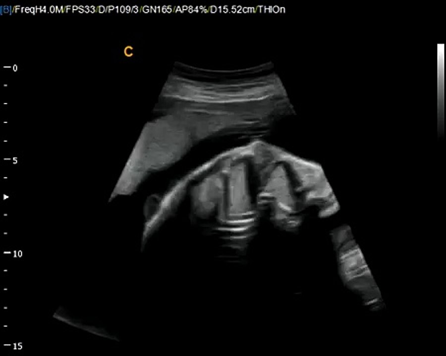 Chison Q9 Color Ultrasound Fetal Heart Very Good image Quality allows to see baby hearts