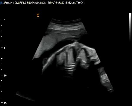 Chison Q9 Color Ultrasound Fetal Heart Very Good image Quality allows to see baby hearts
