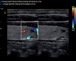 Chison Qbit ThyroidC 2-Amazing Image with Color Doppler Ultrasound