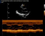 Chison Q9 Ultrasound Color Doppler Qbit Cardiac LVm Short sonography video