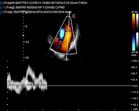 Chison Q9 Cardiac PW Pulse wave Anazing quality for a low cost color doppler ultrasound machine
