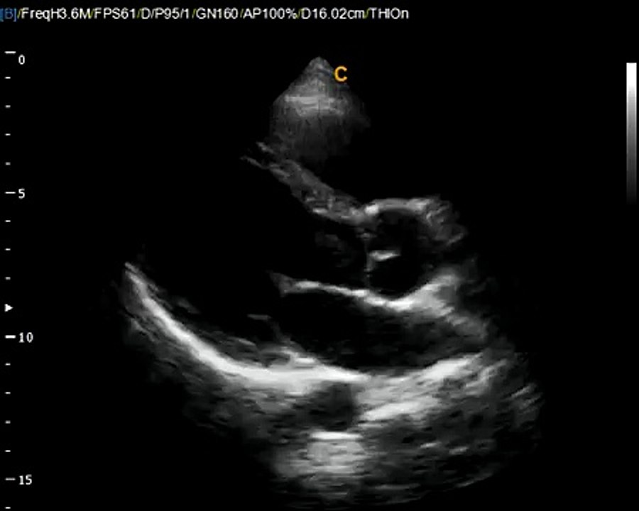 Q9 By Chison Imaging short clip of Cardiac LV Ultrasound