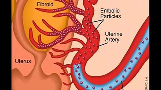 A natural treatment for fibroid tumours - Fibroids Miracle.
