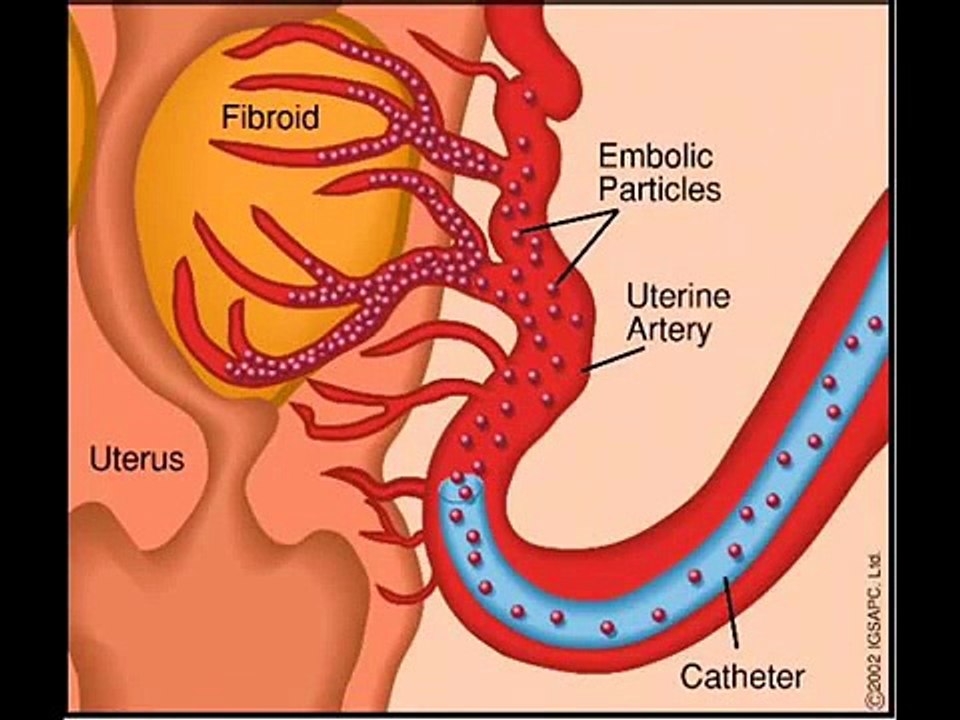 A natural treatment for fibroid tumours - Fibroids Miracle.