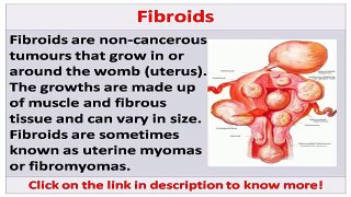 See now fibroids miracle review