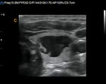 Chison Qbit Thyroid Image, one of best ultrasound for diagnostic examination of Thyroid disease