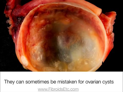 Subserous Fibroids- Natural Treatment [90% of women successfully cured]