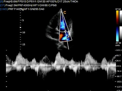 Chison Q5 Cardiac CW Continues Wave most affordable eCo cardiac Ultrasound