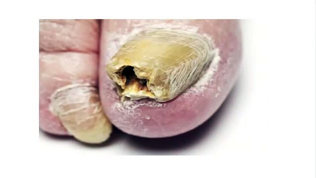 Treat Nail Fungus - Best at Home Toenail Fungus Treatments