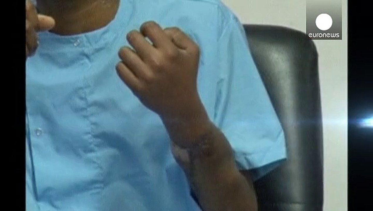 Indien: Erstmals erfolgreich zwei Hände verpflanzt