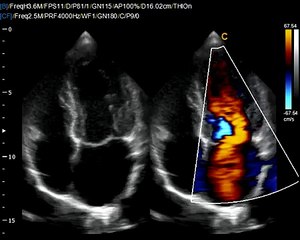 Q9 Chison Eco Cardiac BBC image-Amzing quality for low price , comparable to Mindray M-