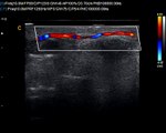 Chison Q9 amazing video of finger blood flow Color Doppler Ultrasound Sonogram