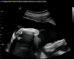 Color Doppler Ultrasound Chison Q5 Fetal ultrasonography Obstetric gynecology application
