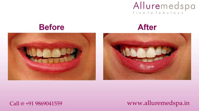 Dental Tooth Cleaning Treatment in Andheri