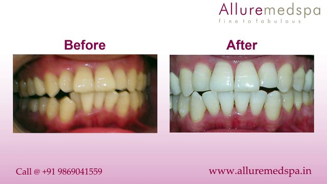 Dental Tooth Polishing Treatment in Andheri