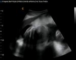 Chison Q5 Fetal Ultrasound -Lowest price of Color Doppler ultrasound