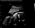 Best Deal on Fetal, neonatal Ultrasound machine-Chison Q5 Fetal Sonogram