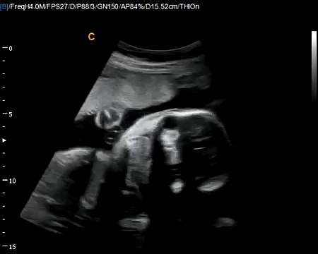 Best Deal on Fetal, neonatal Ultrasound machine-Chison Q5 Fetal Sonogram