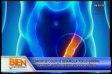 Bien Informado - Información de Cáncer de Colon
