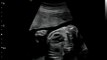 Q5 by Chison  imaging Fetal Heart sonogram , easy to see heart in fetus, neonatal ultrasound