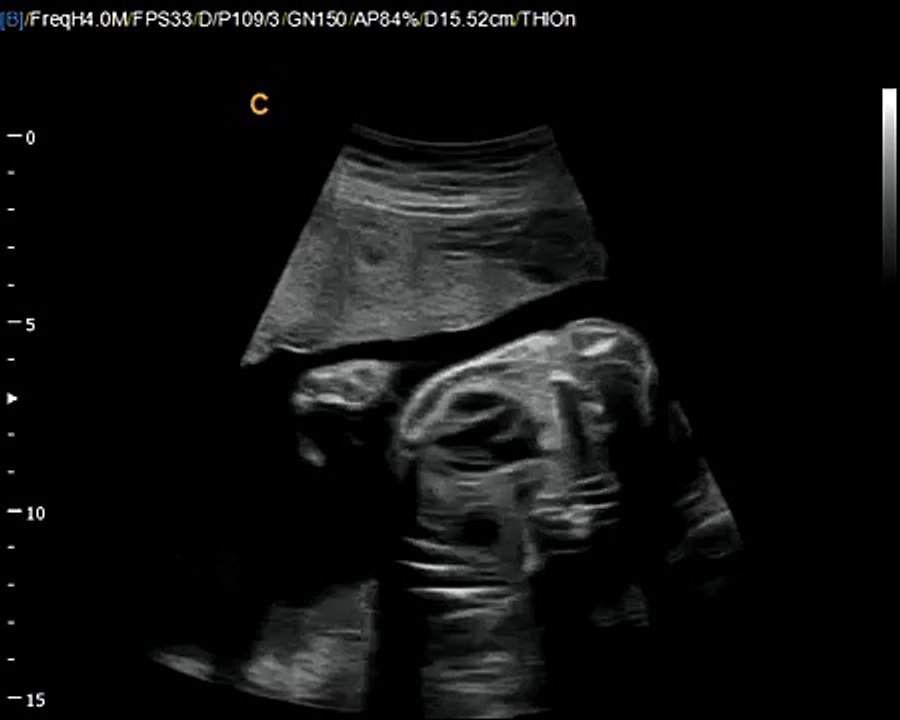 Q5 by Chison  imaging Fetal Heart sonogram , easy to see heart in fetus, neonatal ultrasound