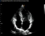 Quality Portble mobile Ultrasound Chison Q9 Cardiac AF video clip