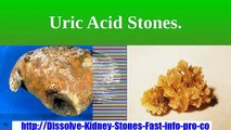 Kidney Stones Symptoms, What Causes Kidney Stones, Stone In Kidney, Struvite Stones