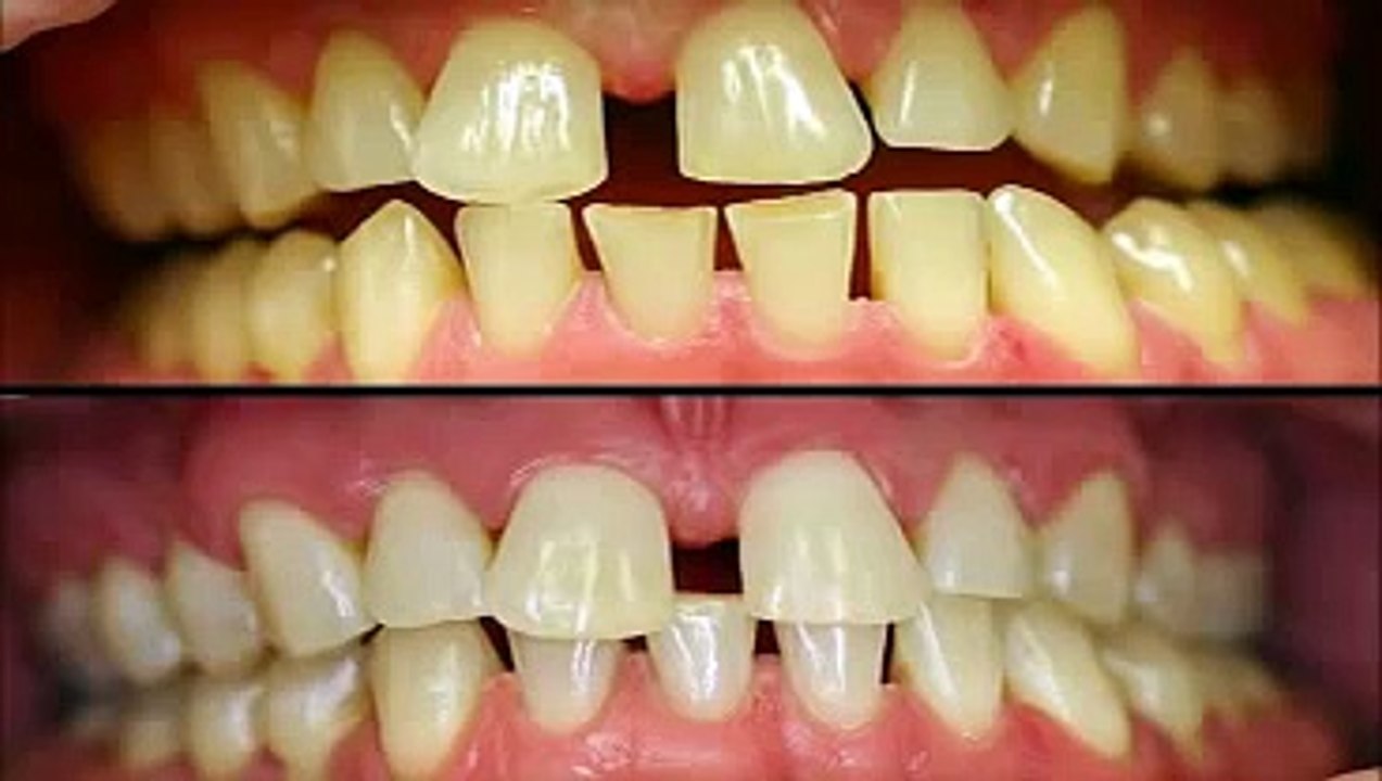 What is teeth bleacning really for?