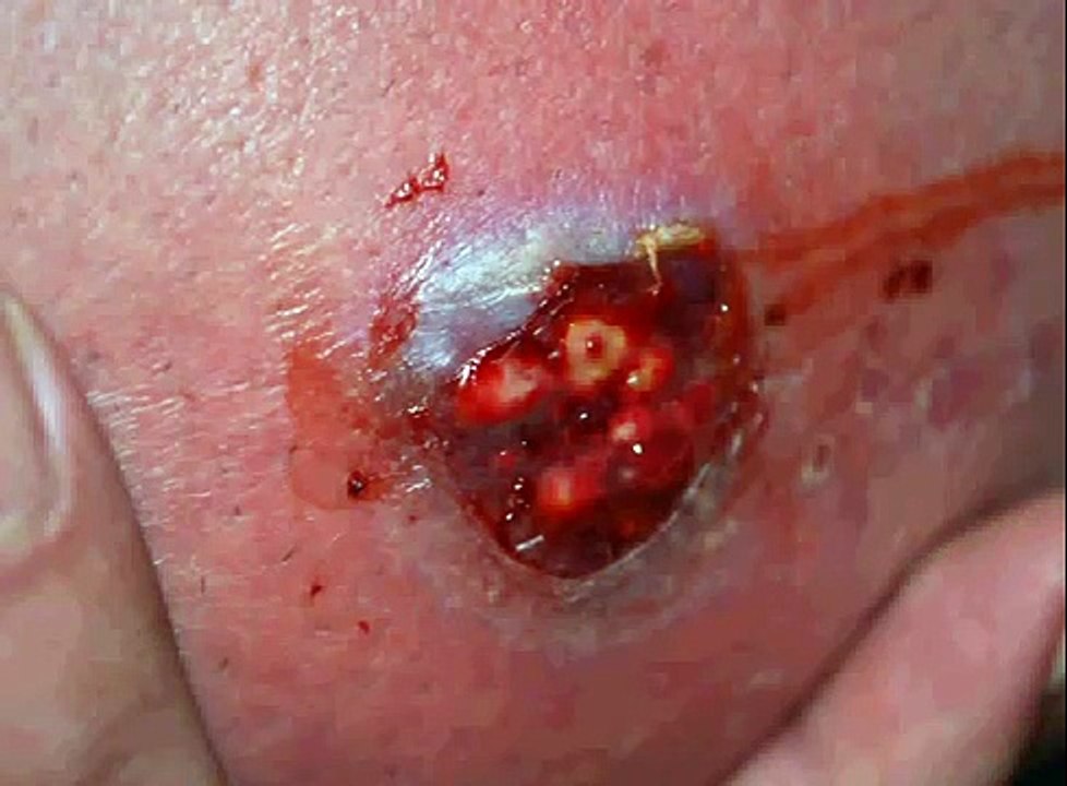 Beware Of Unauthorized Boil Treatments - First Review BoilX - Multiple Symptom Relief For Boils