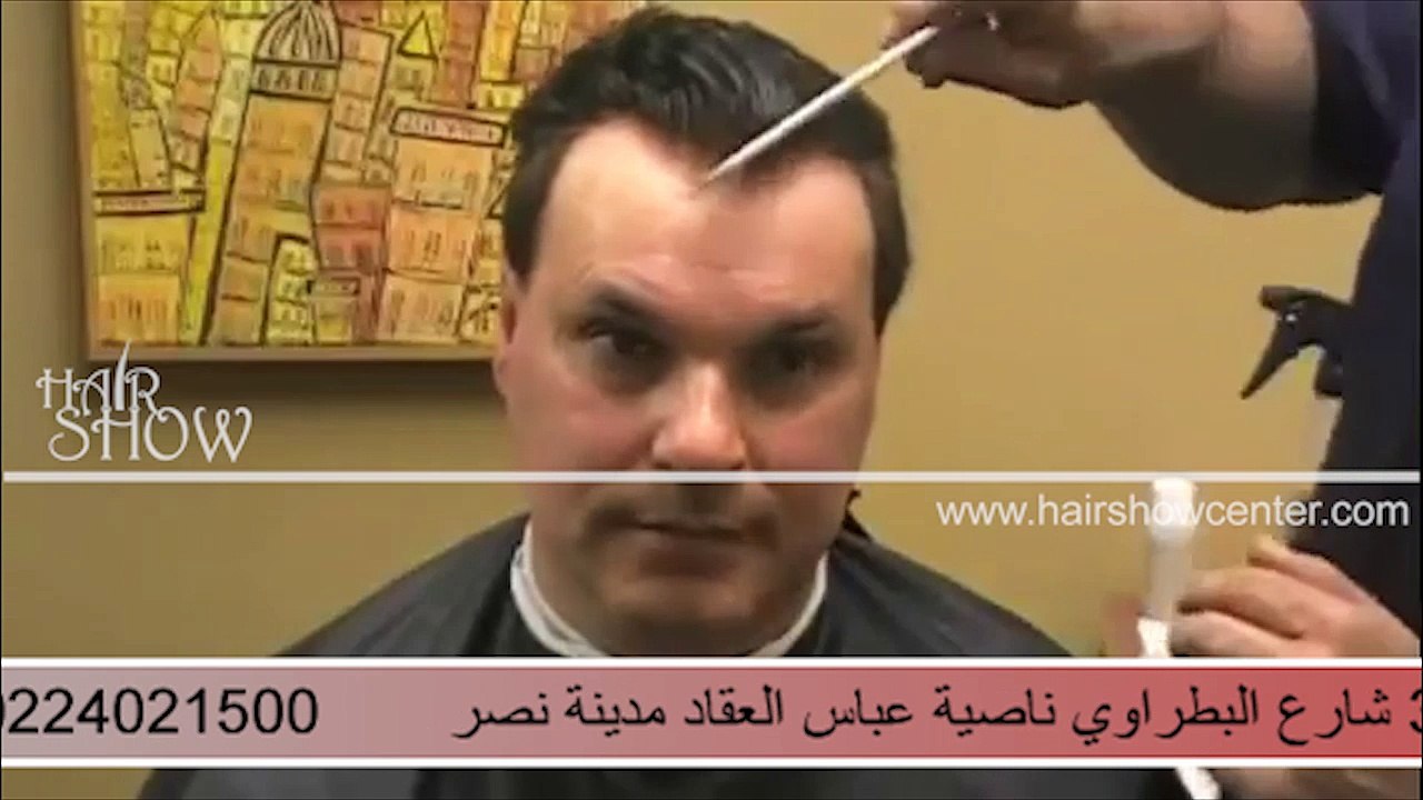 اليونت الألترا ديفينشن فقط من (هيرشوسنتر) علاج الصلع فى اقل من ساعة - طريقة تثبيت و أص اليونت