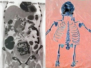 Médicos retiram feto de corpo de mulher 36 anos após gravidez na Índia