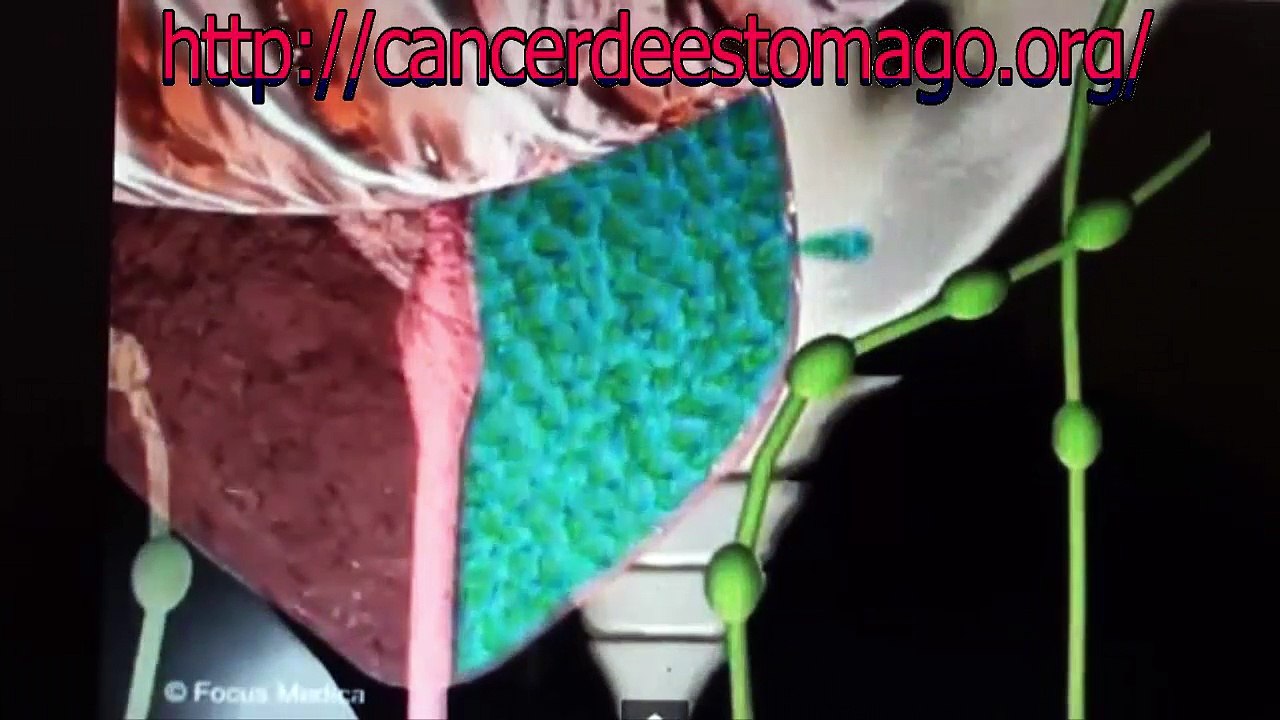 como ataca el cancer de prostata(animacion)