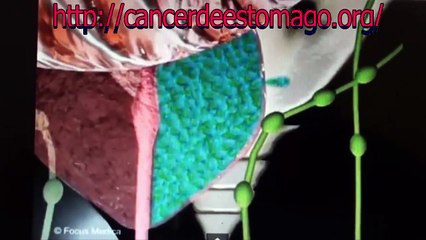 como ataca el cancer de prostata(animacion)