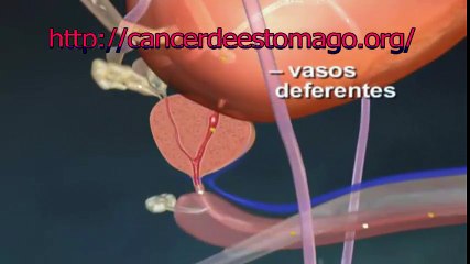 Como se forma el cancer de prostata