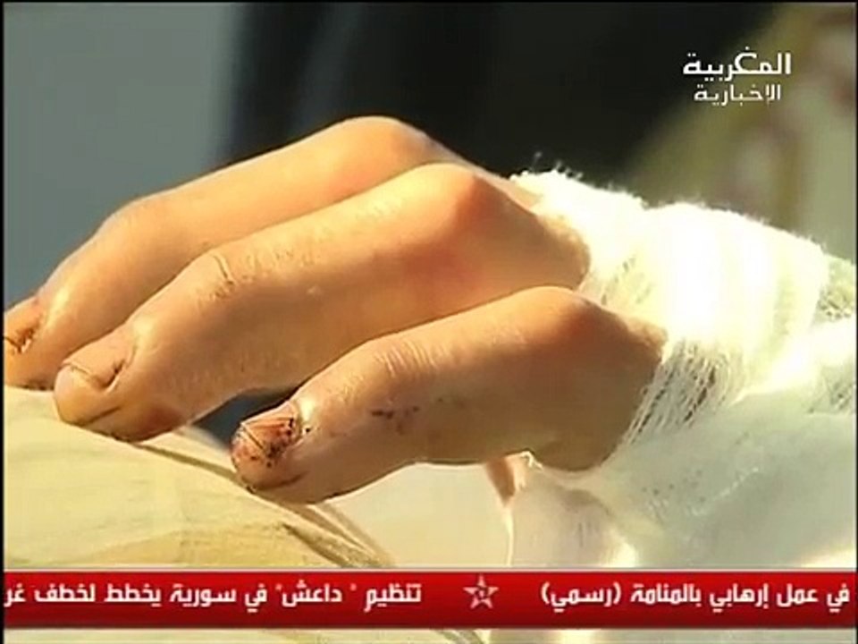 عملية جراحية ناجحة لإعادَة يد مبتُورَة بفاس