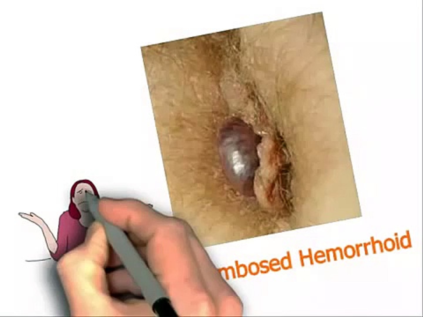 How To Cure Your Thrombosed Hemorrhoid Fast Thrombosed External Hemorrhoid Treatment Video Dailymotion