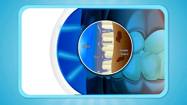 Alta White French Teeth Whitening