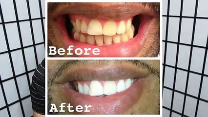 Homemade Teeth Whitening