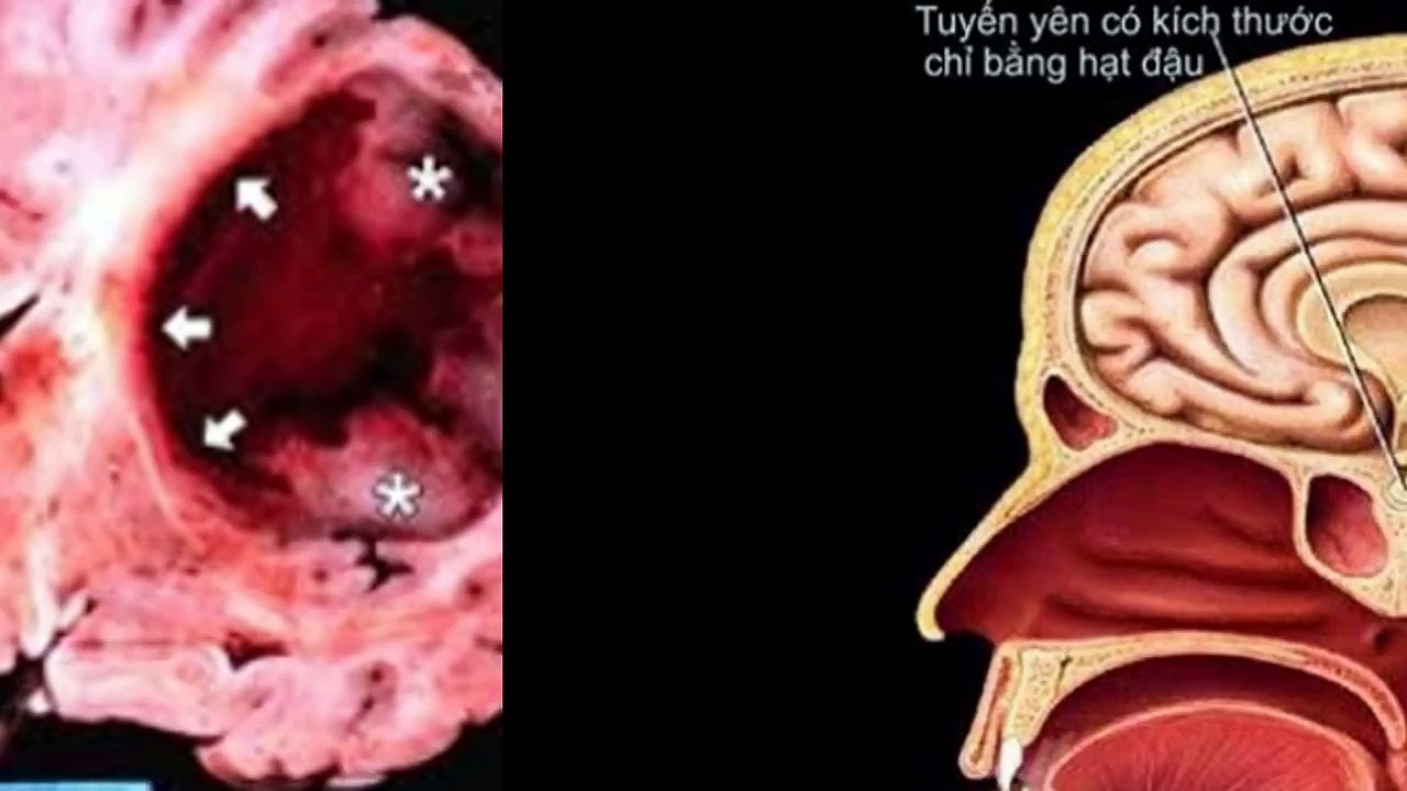 Ung thu nao  - By Benh Vien Ung Buou Hung Viet