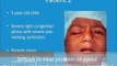 Best Child Droopy Eyes Surgery  Congenital Ptosis Eyelid Treatment in Mumbai, India