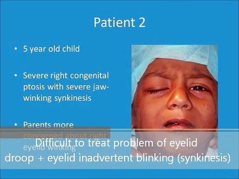 Best Child Droopy Eyes Surgery Congenital Ptosis Eyelid Treatment in Mumbai, India