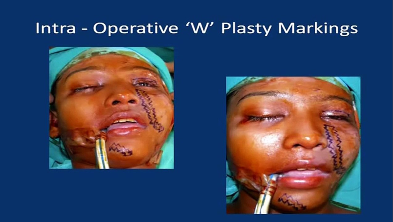 Best Face Scar Removal Surgery & Carbon Dioxide CO2 Laser Treatment Mumbai India